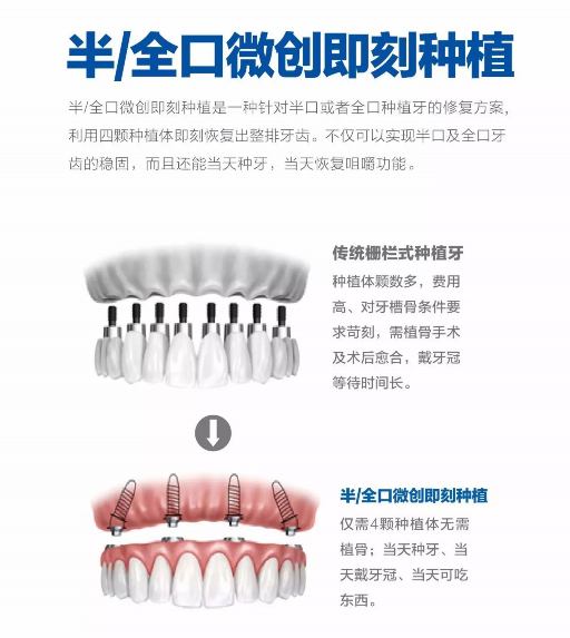 窝沟封闭走进校园需要什么,窝沟封闭情况汇报(图1)